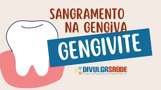 Gengivite Sangramento na Gengiva 